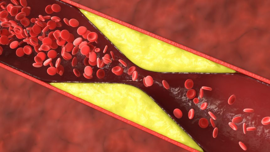 Over 50% of Heart Attacks in Younger Women Aren’t From Clogged Arteries : ScienceAlert