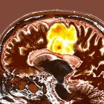 Simple Supplement Combo Could Help Fight Deadly Brain Cancer : ScienceAlert