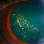 This Rare Condition Makes Your Eyes Sparkle Like a Christmas Tree : ScienceAlert