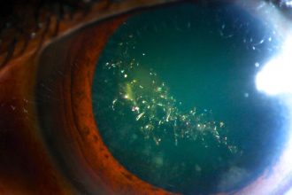 This Rare Condition Makes Your Eyes Sparkle Like a Christmas Tree : ScienceAlert