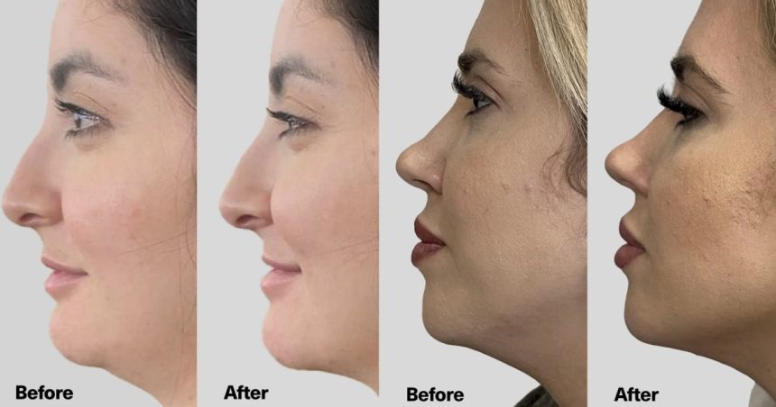This Viral Jaw-Lifting Serum Is Like a Facelift in a Bottle