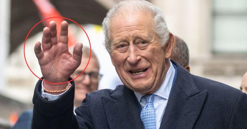 Why Cancer-Battling King Charles’ Fingers are So Swollen