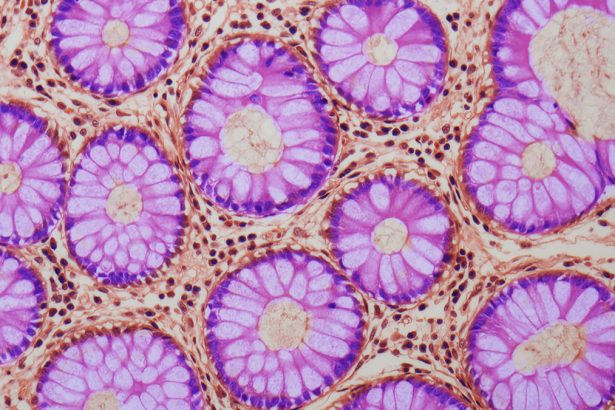 A Hidden Warning Sign Discovered in The Gut May Increase Cancer Risk : ScienceAlert