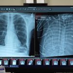 Artificial lungs kept a man alive until he could get a transplant