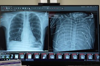 Artificial lungs kept a man alive until he could get a transplant