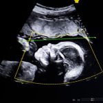 BioticsAI, which won Disrupt’s Battlefield competition in 2023, gains FDA approval for its AI-powered fetal ultrasound product 