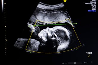 BioticsAI, which won Disrupt’s Battlefield competition in 2023, gains FDA approval for its AI-powered fetal ultrasound product 