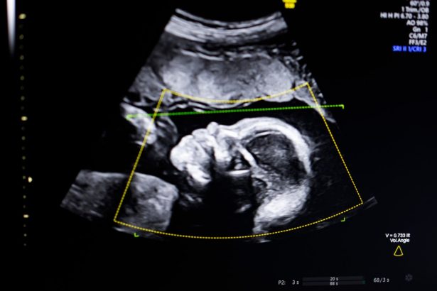 BioticsAI, which won Disrupt’s Battlefield competition in 2023, gains FDA approval for its AI-powered fetal ultrasound product 