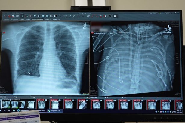 Doctors keep patient alive using ‘artificial lungs’ for two days