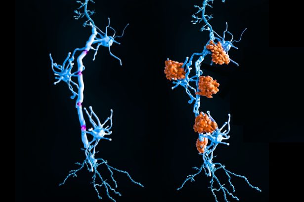 Multiple Sclerosis May Have Two Distinct Subtypes, Scientists Discover : ScienceAlert