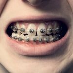Origins of Dental Braces Aren’t as Ancient as We Once Thought : ScienceAlert