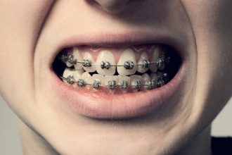 Origins of Dental Braces Aren’t as Ancient as We Once Thought : ScienceAlert