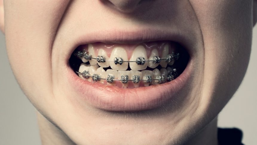 Origins of Dental Braces Aren’t as Ancient as We Once Thought : ScienceAlert
