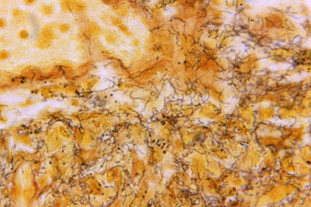 Syphilis, Alex Pretti, Minneapolis health system: Morning Rounds