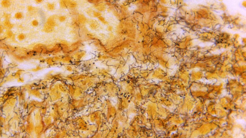 Syphilis, Alex Pretti, Minneapolis health system: Morning Rounds