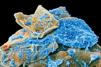 Unusual oral microbiome signature linked to obesity