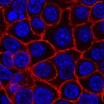 AI-powered cancer tools to guide treatment are emerging