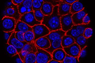 AI-powered cancer tools to guide treatment are emerging