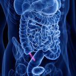 Antibiotics can treat appendicitis for many patients, no surgery needed