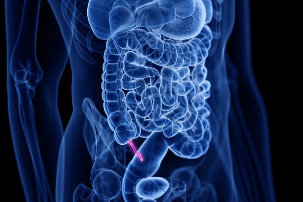 Antibiotics can treat appendicitis for many patients, no surgery needed