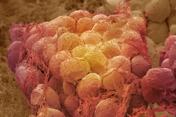 Cells in the body remember obesity. Here’s what that means for weight loss