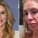 Inside Brandi Glanville’s Facial Parasite Terror That Left Doctors Baffled