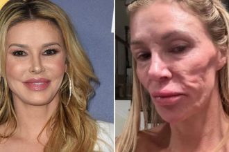 Inside Brandi Glanville’s Facial Parasite Terror That Left Doctors Baffled