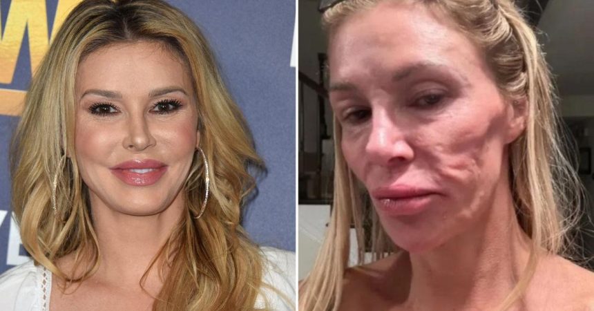 Inside Brandi Glanville’s Facial Parasite Terror That Left Doctors Baffled