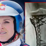 Lindsey Vonn ‘Struggling’ After Last Surgery, Remains Hospitalized in U.S.