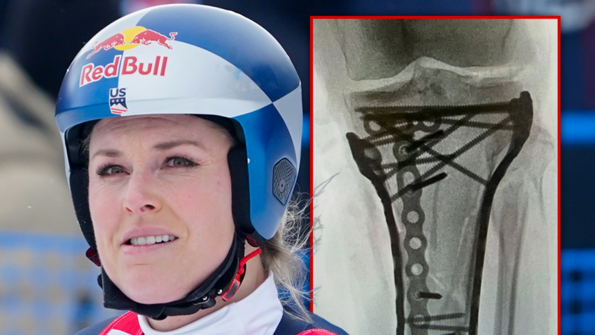 Lindsey Vonn ‘Struggling’ After Last Surgery, Remains Hospitalized in U.S.