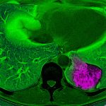 Lung cancer hijacks the brain to trick the immune system