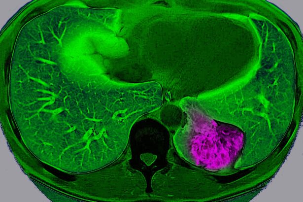 Lung cancer hijacks the brain to trick the immune system