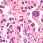 Lung cancer rise among nonsmokers prompts questions on screening