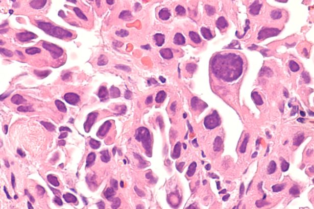 Lung cancer rise among nonsmokers prompts questions on screening