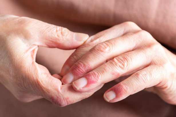 Roivant immune drug significantly outperformed placebo in treating rare skin disease