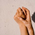 Ruxolitinib: Landmark vitiligo cream targets immune cells that disrupt pigmentation