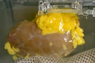 Scientists Created a ‘Universal’ Kidney To Match Any Blood Type : ScienceAlert