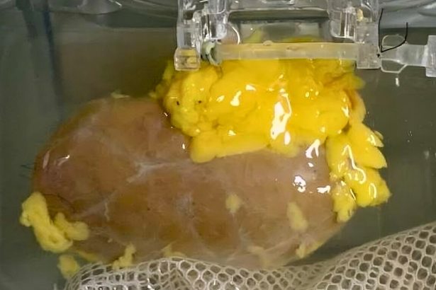 Scientists Created a ‘Universal’ Kidney To Match Any Blood Type : ScienceAlert