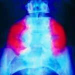 Stem cell patch reverses brain damage in fetuses with spina bifida