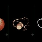 Why heart disease in women may be missed on scans