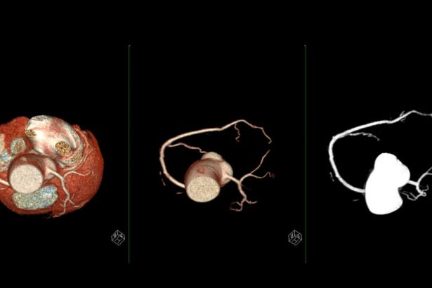 Why heart disease in women may be missed on scans