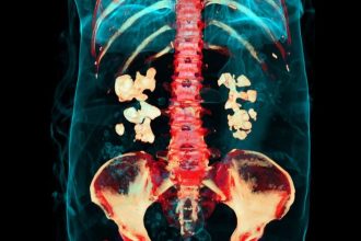 Bacteria Play Previously Unknown Role in Kidney Stones, Study Finds : ScienceAlert