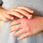 How stress causes an eczema flare up