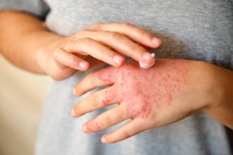 How stress causes an eczema flare up