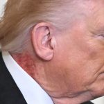 Nasty Rash Seen on President Trump’s Neck at White House Press Conference