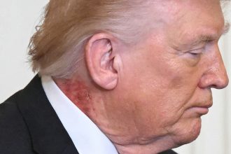 Nasty Rash Seen on President Trump’s Neck at White House Press Conference