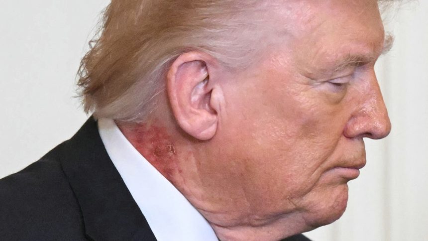 Nasty Rash Seen on President Trump’s Neck at White House Press Conference