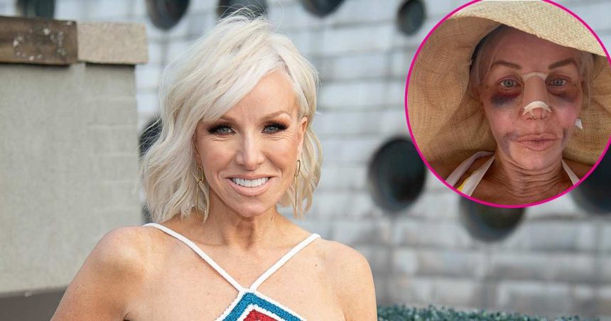 RHONJ Star Margaret Josephs Shows Off Nose Job Results