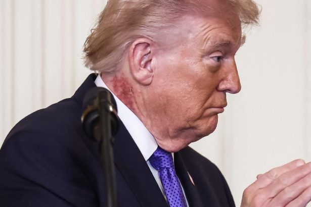 Trump’s Neck Rash Labeled ‘Precancerous Skin Condition’ By Famed Doc