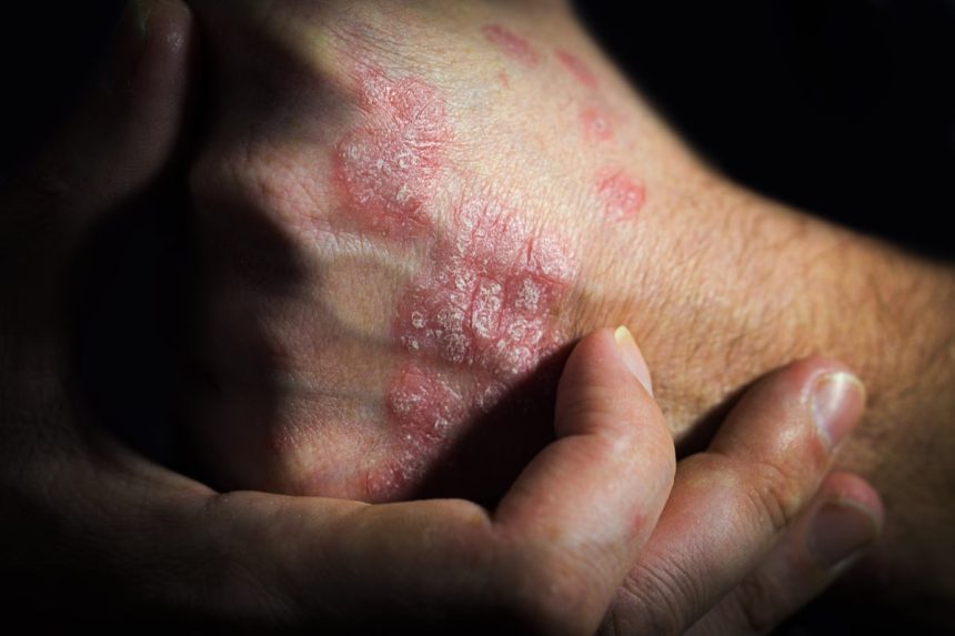 Why your psoriasis flares up in the same spots